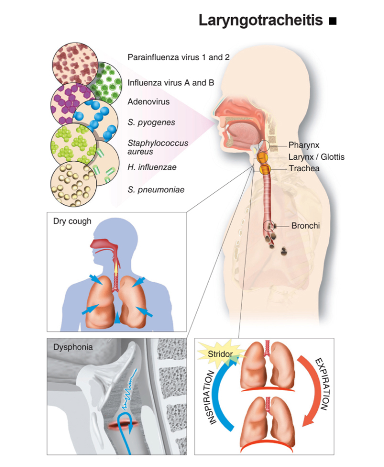 Infografis Acute Laryngotracheitis